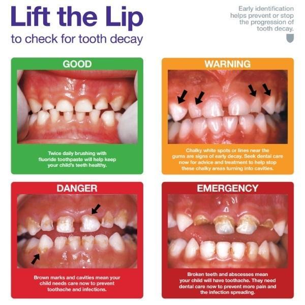 Lift the lip visual to check your child's teeth for tooth decay