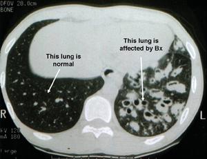 A medical CT scan image of lungs showing a comparison between a normal lung on one side and a lung affected by Bronchiectasis on the other side, with clear labelling indicating the difference.