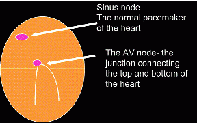 Infographic supraventricular tachycardia.