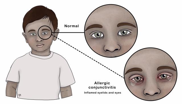 Illustration of a young child showing normal eye appearance and allergic conjunctivitis, where the eyelids and eyes appear inflamed. Close-up insets highlight the difference, with 'Normal' showing clear eyes and 'Allergic conjunctivitis' showing red, swollen eyes with visible irritation.