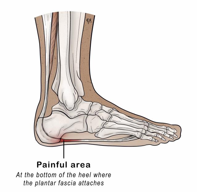 The illustration depicts a side view of the human foot, focusing on the bones, soft tissues, and the painful area at the bottom of the heel where the plantar fascia attaches. The painful area is highlighted in red, with a label pointing to the region to indicate its association with plantar fasciitis.