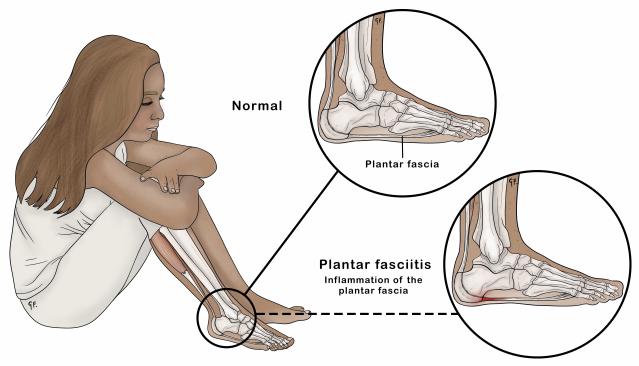 illustration of a child sitting down with 2 insets, one showing normal foot anatomy and the other showing plantar fasciitis