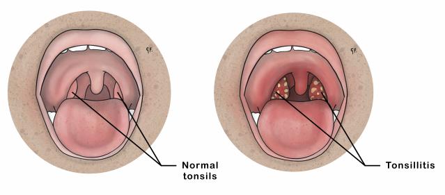 An illustration compares normal tonsils with tonsillitis. The left image shows healthy tonsils with smooth, pink tissue, labeled "Normal tonsils," while the right image depicts swollen, inflamed tonsils with yellow spots, labeled "Tonsillitis."