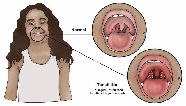 An illustration shows a child with long, wavy hair and a neutral expression, with two detailed circular insets highlighting their throat. The first inset labeled "Normal" shows healthy tonsils and throat, while the second labeled "Tonsillitis" depicts enlarged, inflamed tonsils with yellow spots, illustrating the difference between a healthy and infected throat.