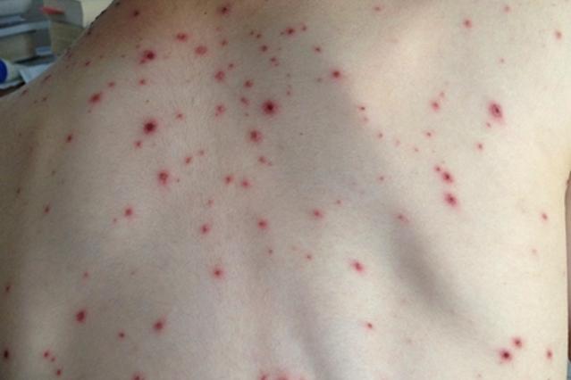 Photo of a child's back with multiple chickenpox lesions