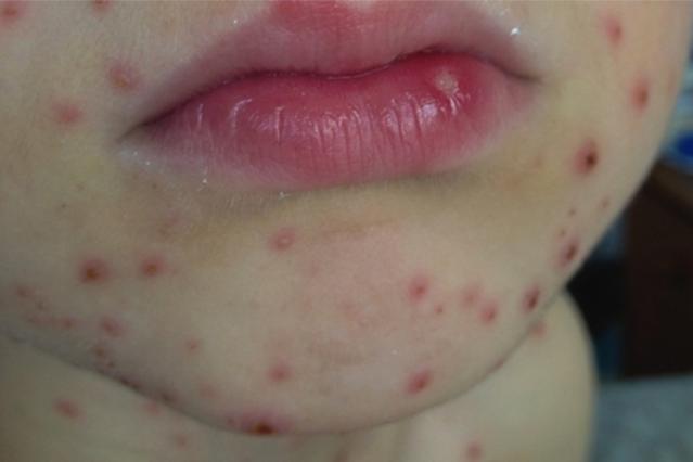 Photo showing a close up of a child's chin and mouth with multiple chickenpox lesions