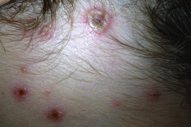 Photo showing a child's scalp with multiple chickenpox lesions