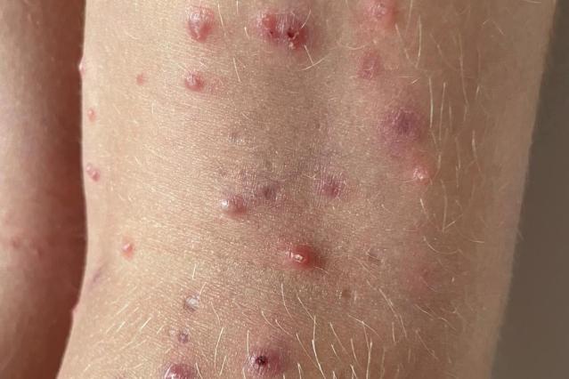 A close up photograph of the back of a child's knees showing a molluscum rash