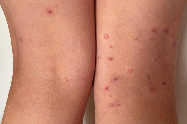 A photograph of the back of a child's knees showing a molluscum rash