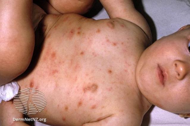 Baby with a scabies rash over trunk