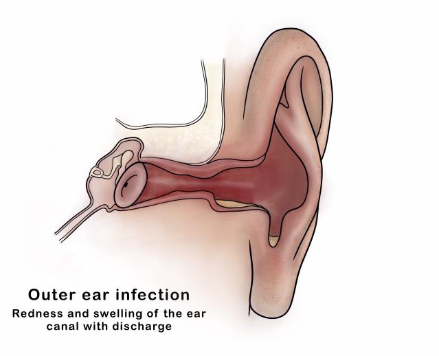 Illustration showing the anatomy of an outer ear infection