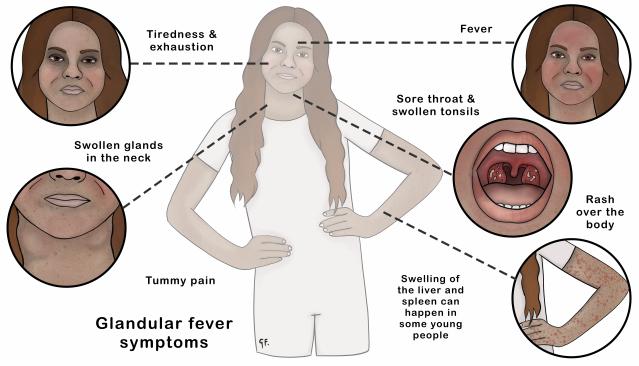 An illustration showing a teenager with the common symptoms of glandular fever