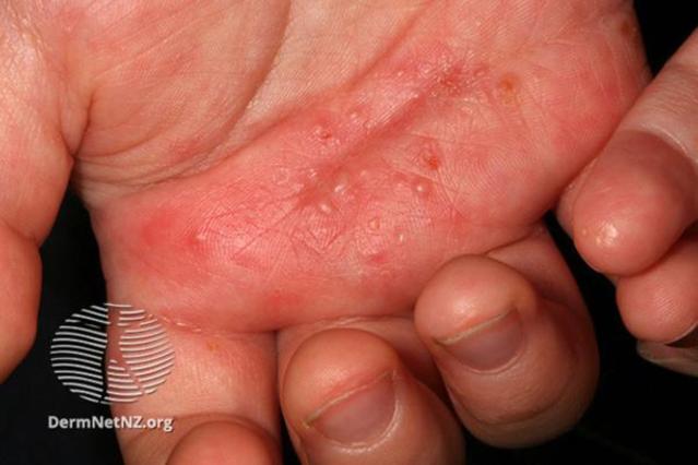 Scabies rash on the palm of a young child