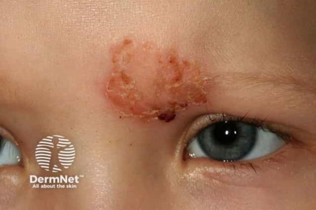 School sore on child's forehead