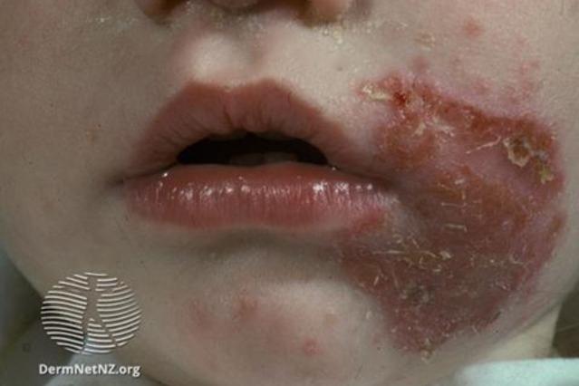 School sore on child's cheek