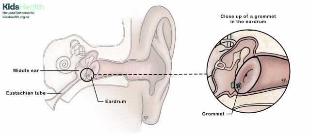 Illustration showing the anatomy of an ear with a grommet close up