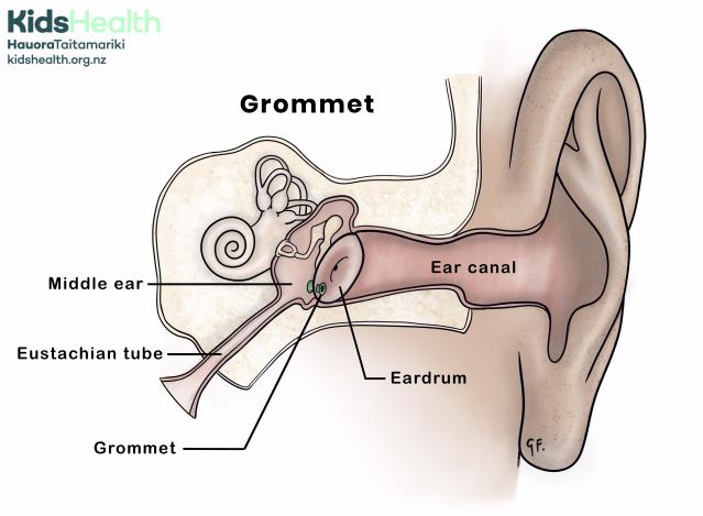 Illustration showing the anatomy of an ear with a grommet