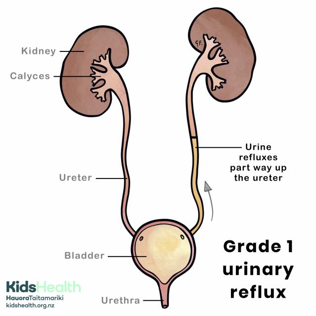Illustration of grade 1 urinary reflux showing urine refluxing partway up the ureter.
