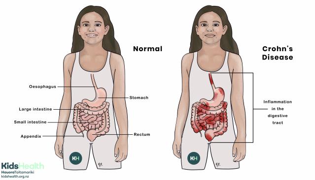 Illustration comparing a normal digestive system with Crohn’s Disease. The Crohn’s diagram shows red areas of inflammation throughout the digestive tract.