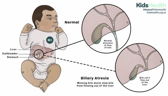 An illustration comparing a normal liver and bile ducts with biliary atresia in an infant. In biliary atresia, the bile ducts are missing or blocked, preventing bile from flowing out of the liver.