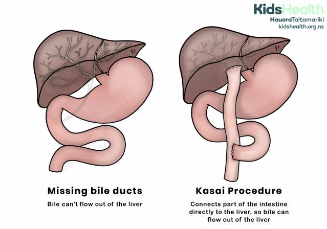 Two side-by-side illustrations show how missing bile ducts block bile flow, and how the Kasai procedure restores it by connecting the intestine directly to the liver.