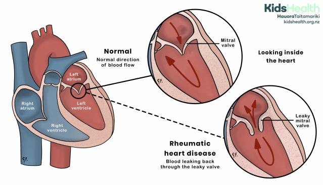 An illustration comparing a normal heart and a heart affected by rheumatic heart disease. The normal heart shows blood flowing in one direction through the mitral valve. In rheumatic heart disease, the mitral valve is leaky, and some blood flows backward.