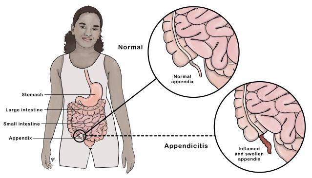 Illustration of a teenage girl showing digestive tract anatomy with insets of a normal and inflammed appendix (appendicitis) 