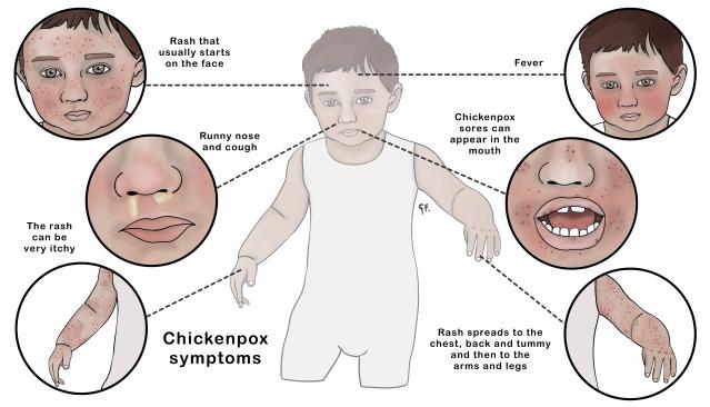 Illustration of a child showing insets with chickenpox symptoms