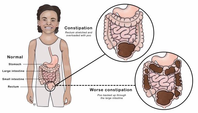 Illustration of a child with a normal digestive system and two close-up views of the intestines showing different stages of constipation. The first close-up shows constipation with the rectum overloaded with stool. The second shows worse constipation, with stool backed up through the large intestine. Labels identify the stomach, large intestine, small intestine, and rectum.