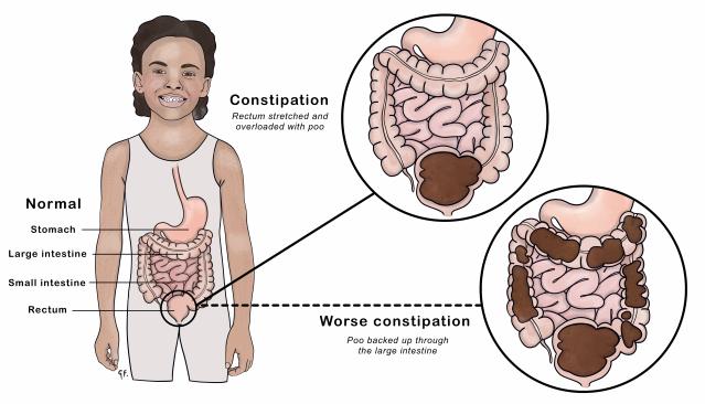  Illustration of a child with a normal digestive system and two close-up views of the intestines showing different stages of constipation. The first close-up shows constipation with the rectum overloaded with stool. The second shows worse constipation, with stool backed up through the large intestine. Labels identify the stomach, large intestine, small intestine, and rectum.