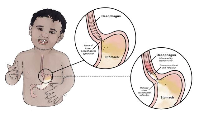 This illustration shows a baby with a close-up view of the esophagus and stomach, explaining gastroesophageal reflux. The left inset depicts a normal lower esophageal sphincter, while the right inset shows the relaxed sphincter, allowing stomach acid and milk to flow back, causing inflammation in the esophagus.