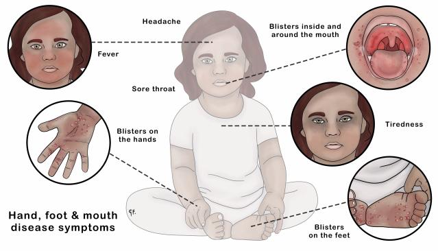 This illustration shows a child with symptoms of hand, foot, and mouth disease, including fever, headache, sore throat, tiredness, blisters on the hands and feet, and blisters inside and around the mouth. Each symptom is highlighted in close-up circles around the child for clarity.