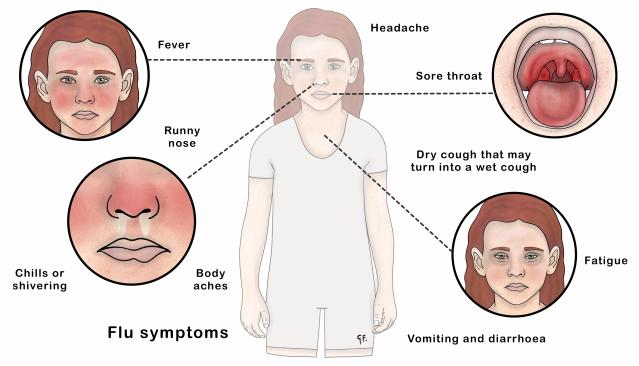 This illustration shows a child with symptoms of the flu, including fever, headache, sore throat, runny nose, chills or shivering, body aches, fatigue, vomiting, diarrhea, and a dry cough that may turn into a wet cough. Each symptom is highlighted in close-up circles around the child for clear identification.