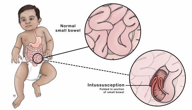 Image of a young child showing insets with normal bowel and intussusception