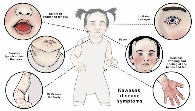 An illustration showing a small child with insets illustrating the symptoms of kawasaki disease