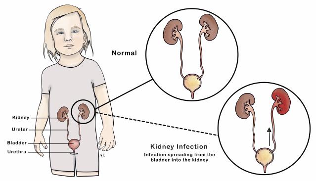 Illustration of a young child with the urinary system labeled, showing the kidneys, ureters, bladder, and urethra. Enlarged views depict a normal urinary system and a kidney infection where the infection spreads from the bladder to the kidney, with one kidney highlighted in red to indicate inflammation.