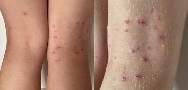 Photos of small raised bumps on the skin - molluscum contagiosum