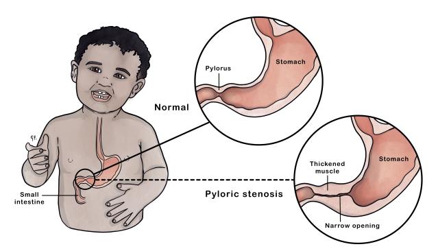 Illustration of a young baby with insets highlighting a normal pylorus and pyloric stenosis