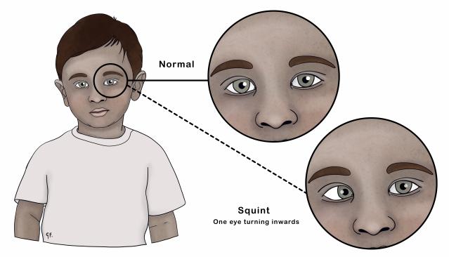 Illustration of a young child showing normal eye alignment and a squint, where one eye turns inward. Close-up insets highlight the difference, with 'Normal' showing both eyes aligned and 'Squint' showing one eye turned inward.