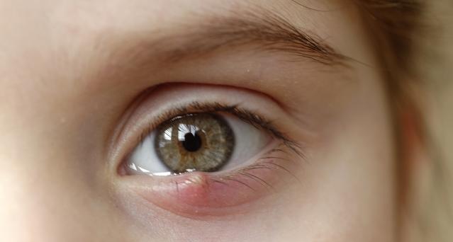 A child with a stye on the lower eyelide of their left eye