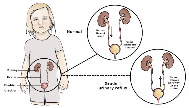 Illustration of a child with insets highlighting normal genitourinary system and urinary reflux. 