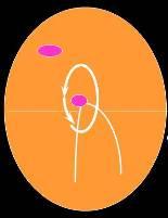 Diagram showing atrio-ventricular nodal re-entrant tachycardia