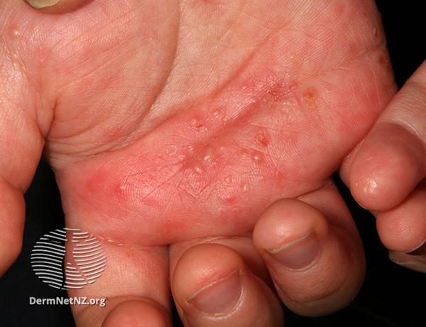 Child's hand with scabies