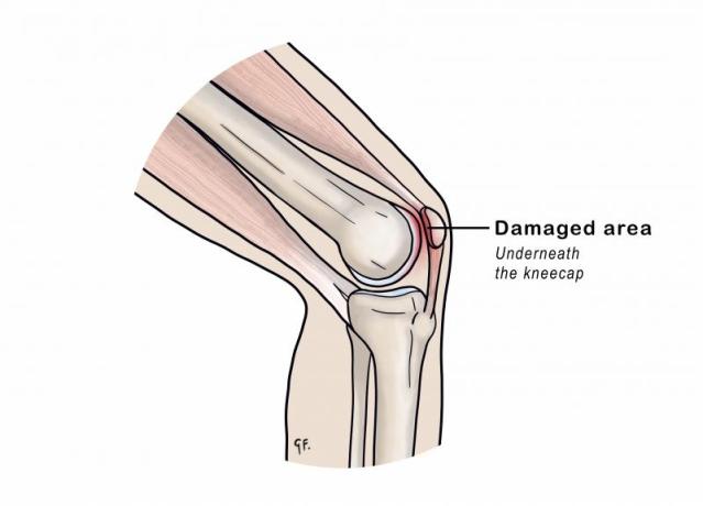 Illustration showing painful area in chondromalacia patella