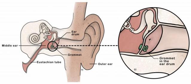 Illustration showing inner ear anatomy with a grommet in place