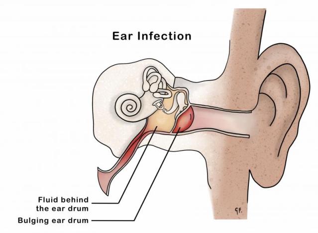 Illustration showing inner ear anatomy with an ear infection or otitis media