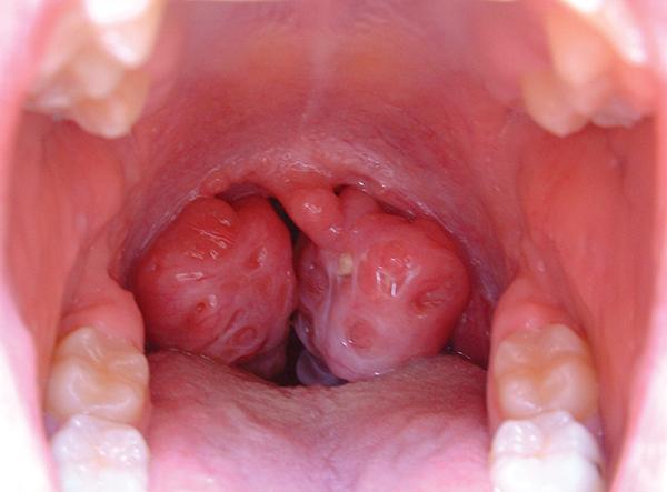 Photo of the back of the throat of a child showing enlarged tonsils