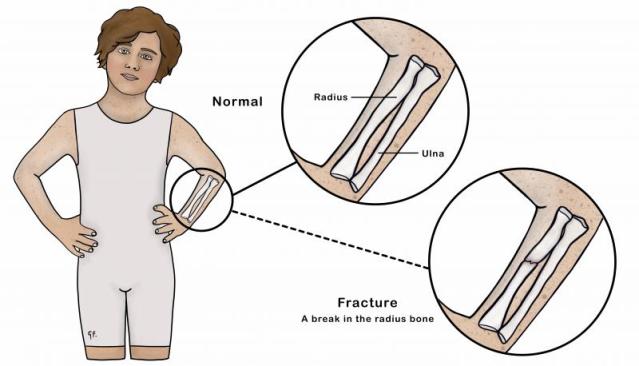 Illustration showing a child comparing normal arm bones to an arm with a broken bone 