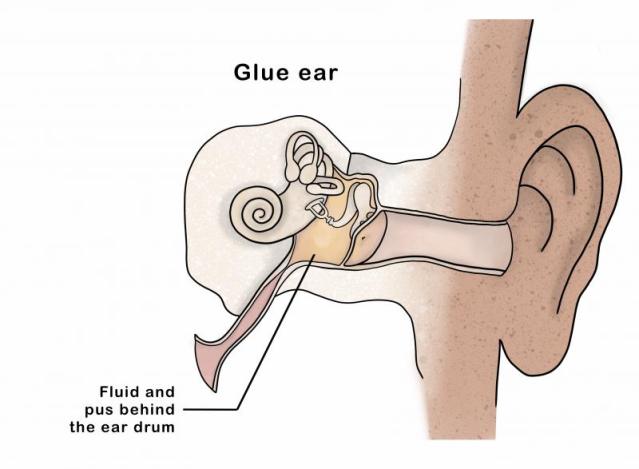 Diagram of the ear showing fluid in the middle ear