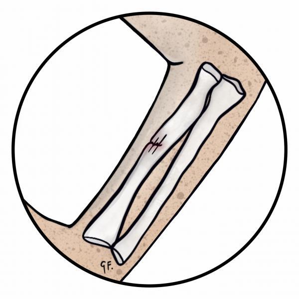 Illustration of a greenstick fracture of the arm